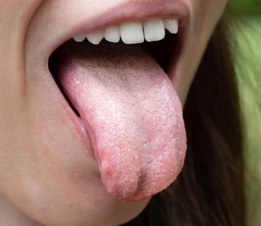 What Are the Symptoms of Oral Thrush, and How Can You Prevent It?
