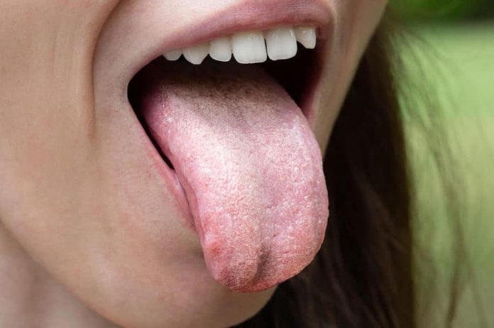 oral-thrush-1200x628-1
