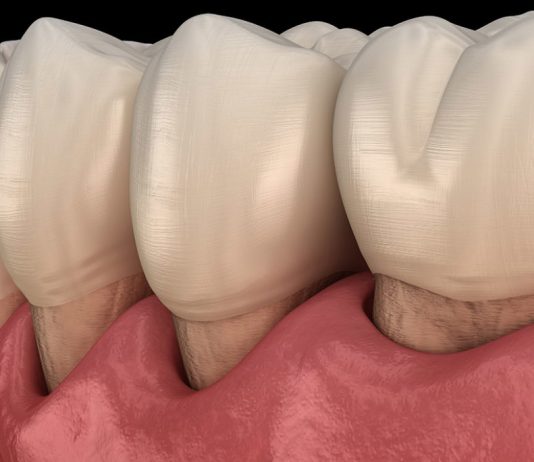 What Are Abfractions and How Can They Impact Your Smile?