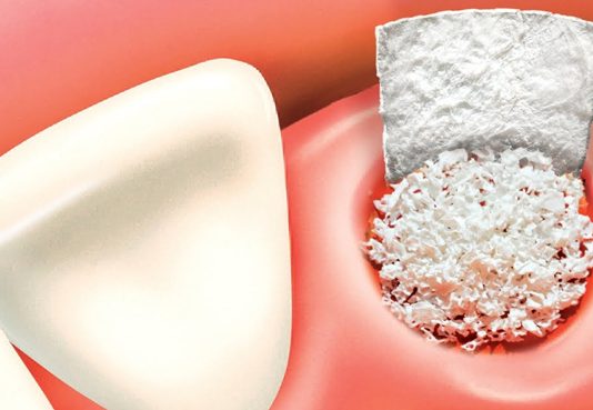 When Is a Bone Graft Necessary?