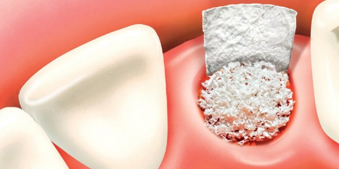 bone_grafting_main