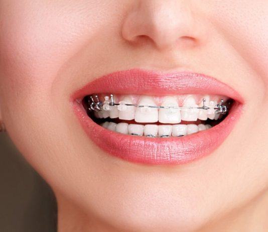 Are Self-Ligating Braces a Good Option For Your Child?