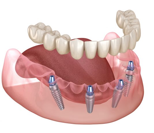 Who Might Benefit From All-on-Four Dental Implants?