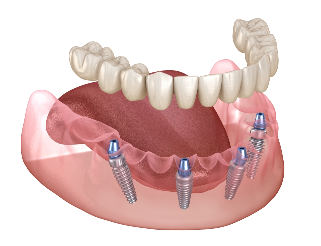 Who Might Benefit From All-on-Four Dental Implants?