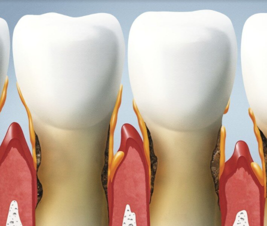 What Causes Bone Resorption in the Mouth?