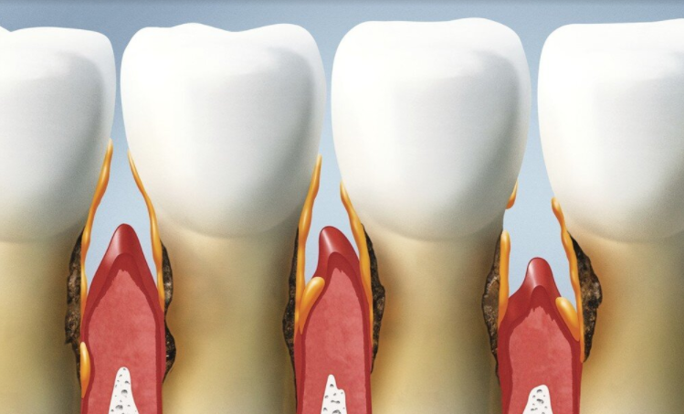 What Causes Bone Resorption in the Mouth?