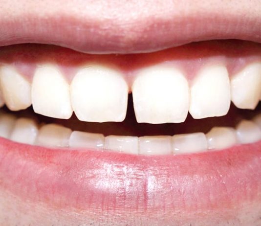 What Kind of Dental Work Can Fix Gapped Teeth?