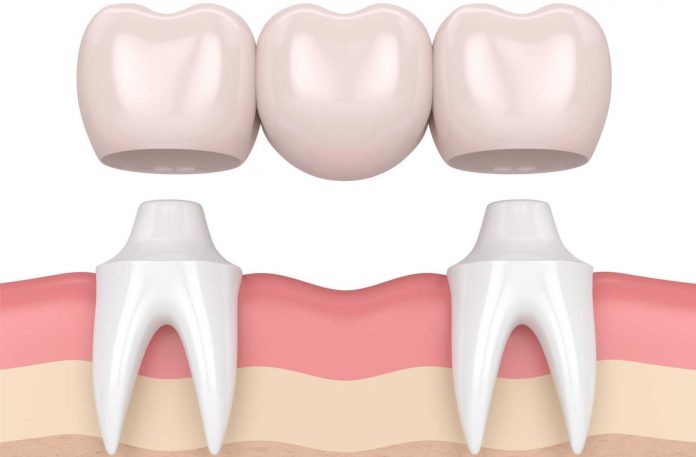 dental-bridge-vector