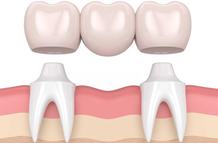 Understanding the Advantages and Disadvantages of Dental Bridges