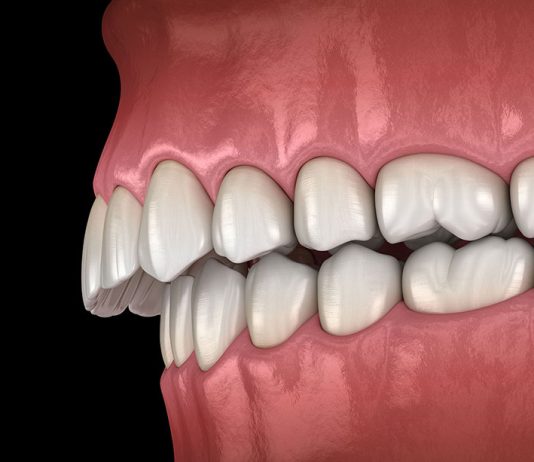 Your Overbite or Underbite Can Cause Long-Term Health Issues