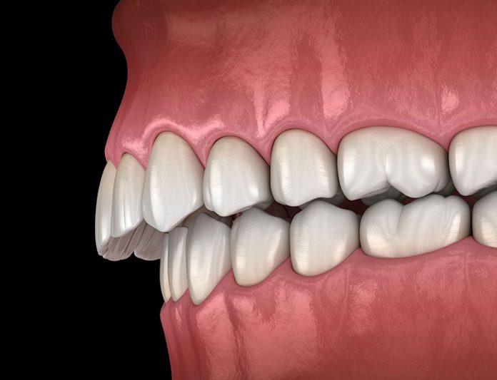 overbite-graphic-fix