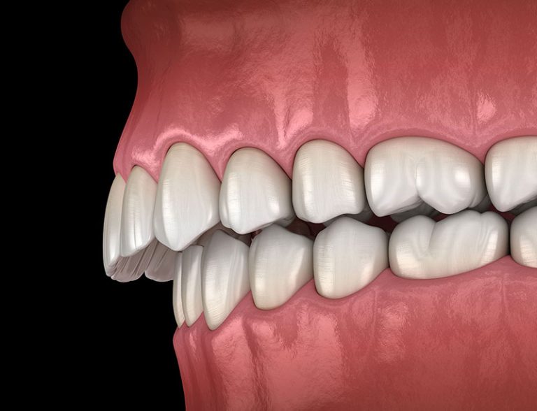 Your Overbite or Underbite Can Cause Long-Term Health Issues