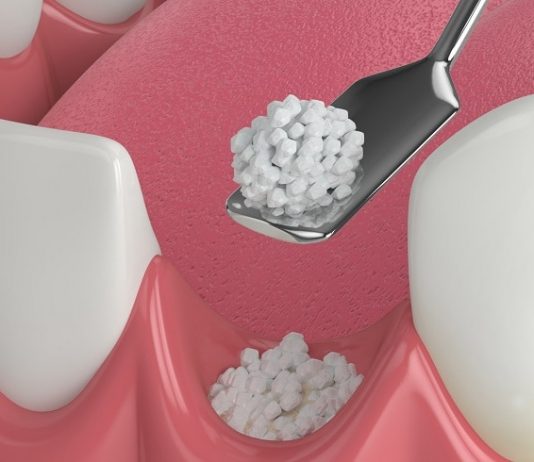 When Are Bone Grafts Necessary?