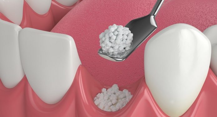 placing-bone-tissue-for-dental-bone-graft