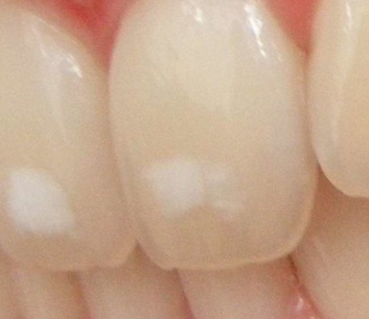 Treatment Options for Removing Spots on Teeth