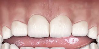 What Is the Potential Impact of Tongue Thrusting, and How Is It Treated?