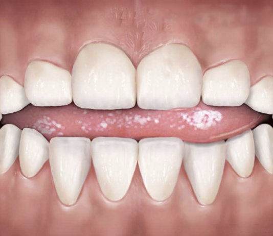 What Is the Potential Impact of Tongue Thrusting, and How Is It Treated?