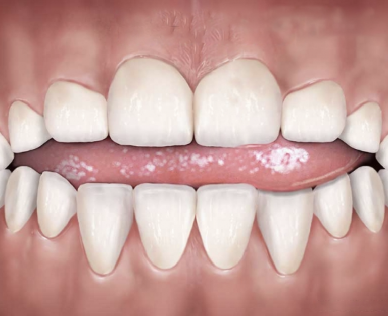 What Is the Potential Impact of Tongue Thrusting, and How Is It Treated? What Is the Potential Impact of Tongue Thrusting, and How Is It Treated?