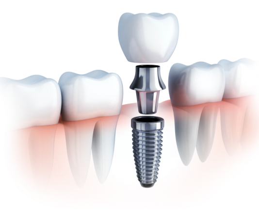 Signs That Your Dental Implant May Be Failing