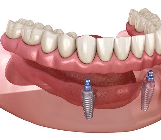 What Are the Benefits of Implant-Supported Dentures?