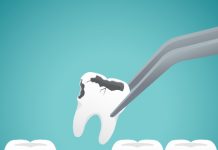 How to Prevent Dry Socket After Tooth Extraction