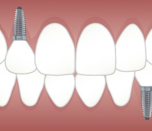 Why Would a Dental Implant Fail?