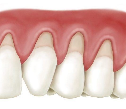Why Are Your Gums Receding Under Your Dental Crowns?