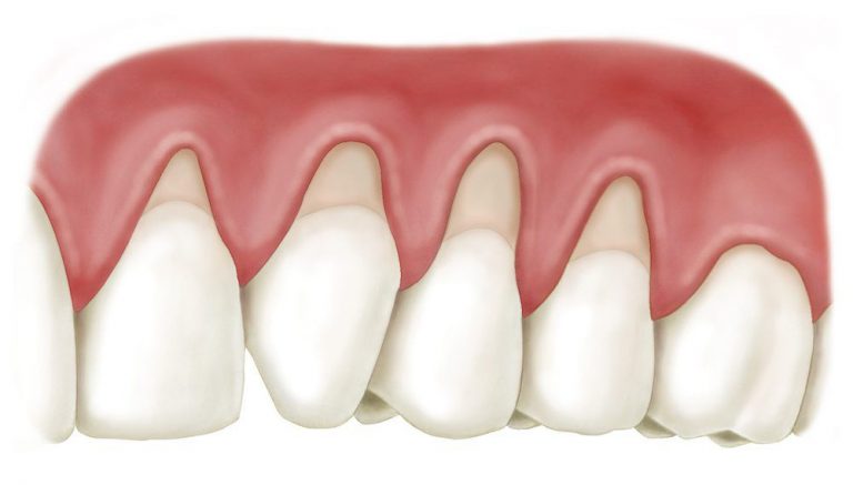 Why Are Your Gums Receding Under Your Dental Crowns? Why Are Your Gums Receding Under Your Dental Crowns?