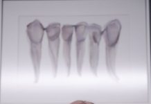 What Are the Signs That I Need My Wisdom Teeth Removed? wisdom teeth removal aldie dentist