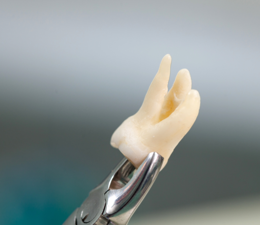 What Are the Longer-Term Impacts of Not Addressing a Gap in Your Smile After a Tooth Extraction? Tooth Extraction