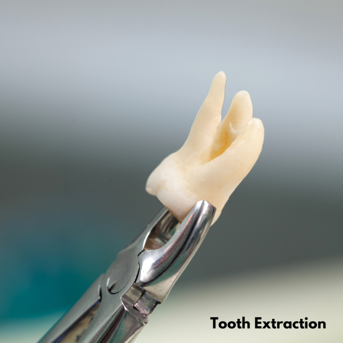 Tooth Extraction