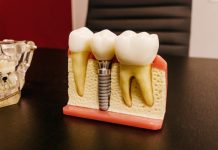 How Do Dentists Regenerate Jawbone in Order to Place Dental Implants? dental implant orangevale ca