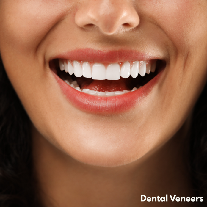 Dental Veneers Dental Veneers