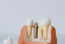 What Happens During the Dental Crown Procedure? dental crown
