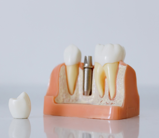 What Happens During the Dental Crown Procedure? dental crown
