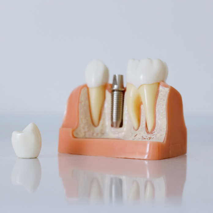 Untitled design dental crown