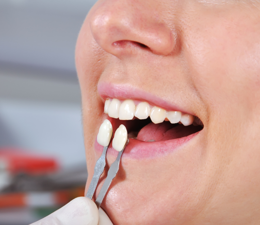 What’s the Difference Between Dental Veneers and Crowns? dental veneers