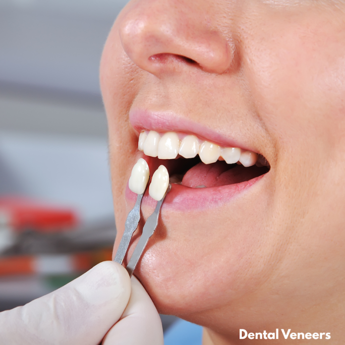 Dental Veneers dental veneers