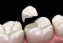 Can a Cracked Tooth Heal on Its Own? cracked tooth