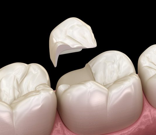 Can a Cracked Tooth Heal on Its Own? cracked tooth