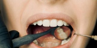 How Soon Can I Eat After a Dental Filling? dental filling