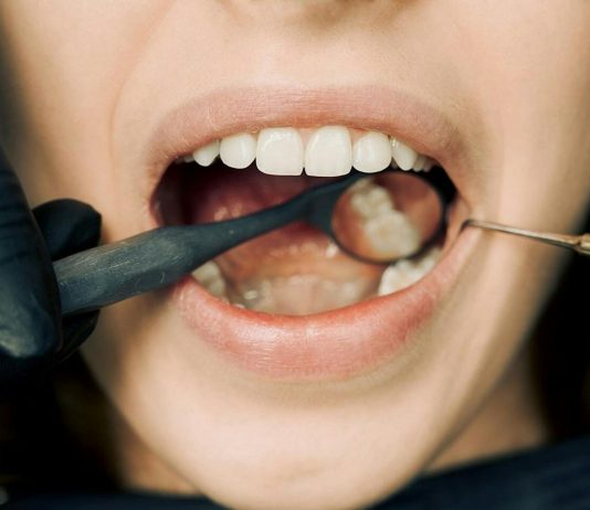 How Soon Can I Eat After a Dental Filling? dental filling