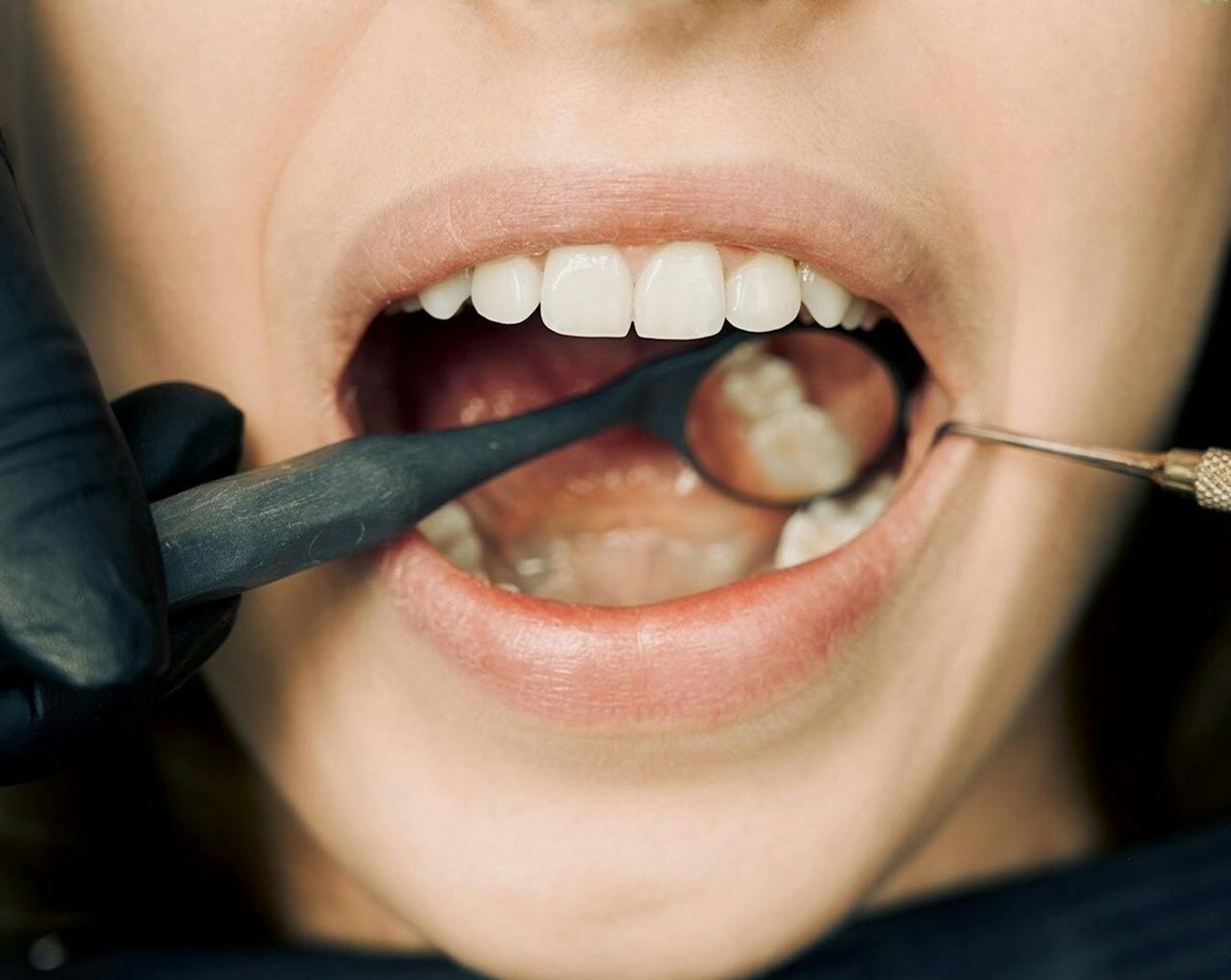 How Soon Can I Eat After a Dental Filling?