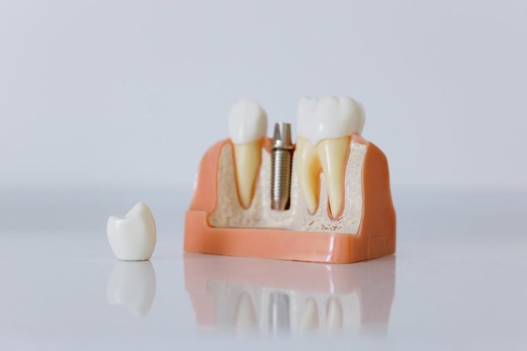 Why It Is Important to Replace an Extracted Tooth