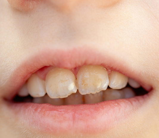 Are Discolored Teeth a Sign of Poor Dental Health? discolored teeth