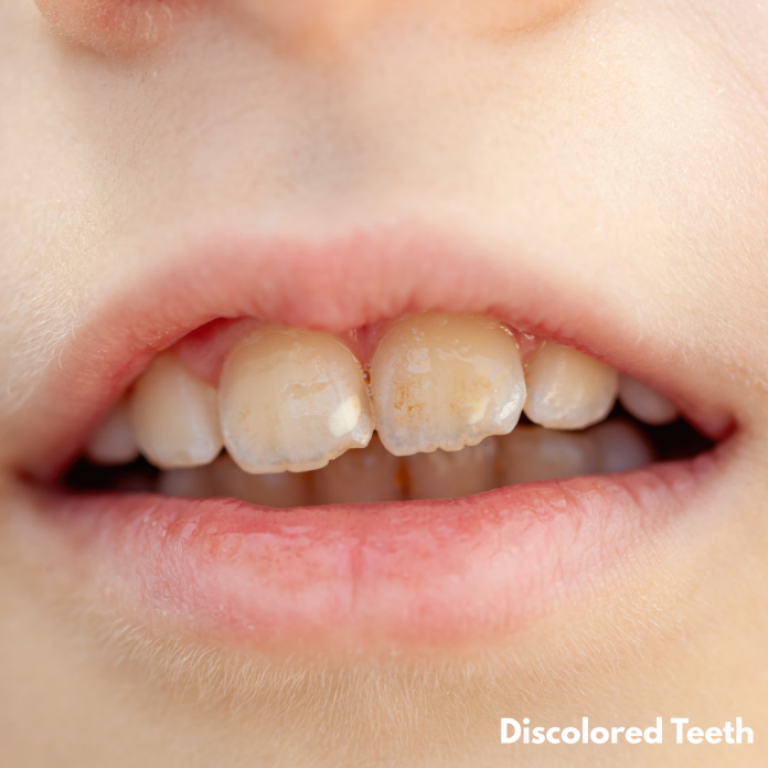 Discolored Teeth discolored teeth
