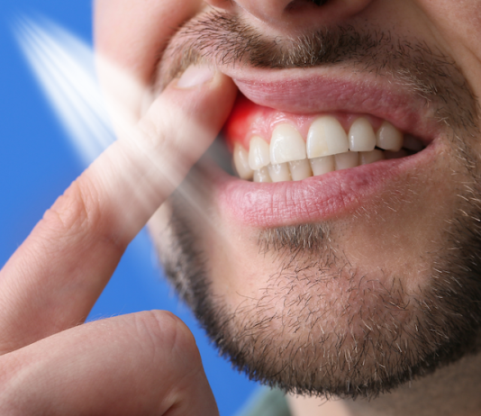 Is Gummy Smile Considered a Dental Problem or Just a Cosmetic Issue? periodontal care