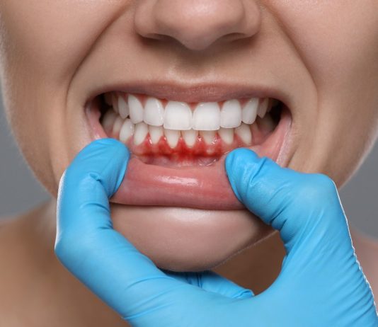 Are Bleeding Gums Linked to Other Health Conditions Like Diabetes or Heart Disease? bleeding gums gum disease