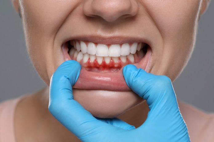 bleeding gums gum disease