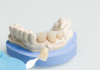 Tips for Maintaining Your Dental Veneers or Crowns for Long-Term Aesthetics dental veneers
